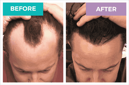 Before and after hair transplant