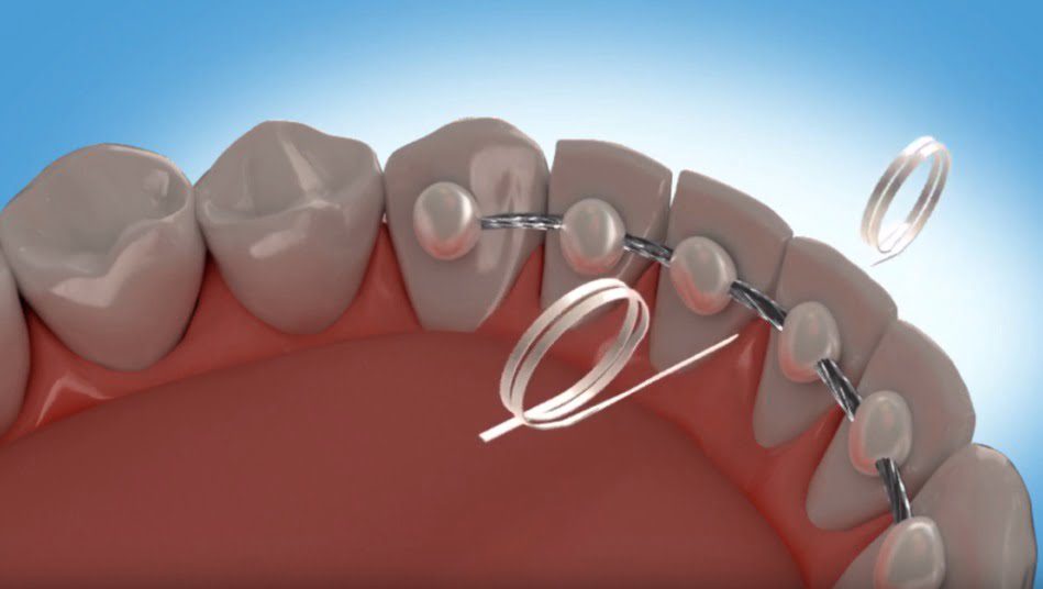 Flossing with a permanent retainer