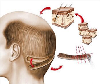 fue hair transplant